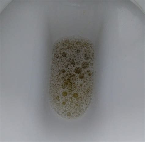 Protein excreted in urine is known as Proteinuria. . Protein in urine reddit